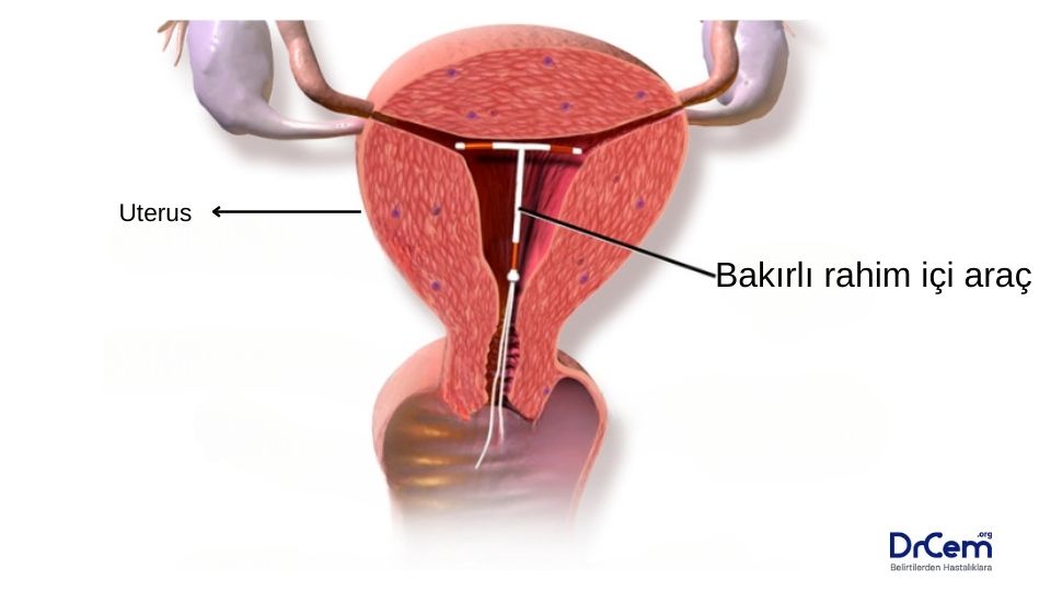 Bakırlı Rahim İçi Araç görseli - DrCem hastalık rehberi